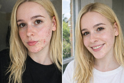 Before and after comparison of a customer with acne on their face showing results after using the clarity elixir and detox clay face mask from gentle roots.