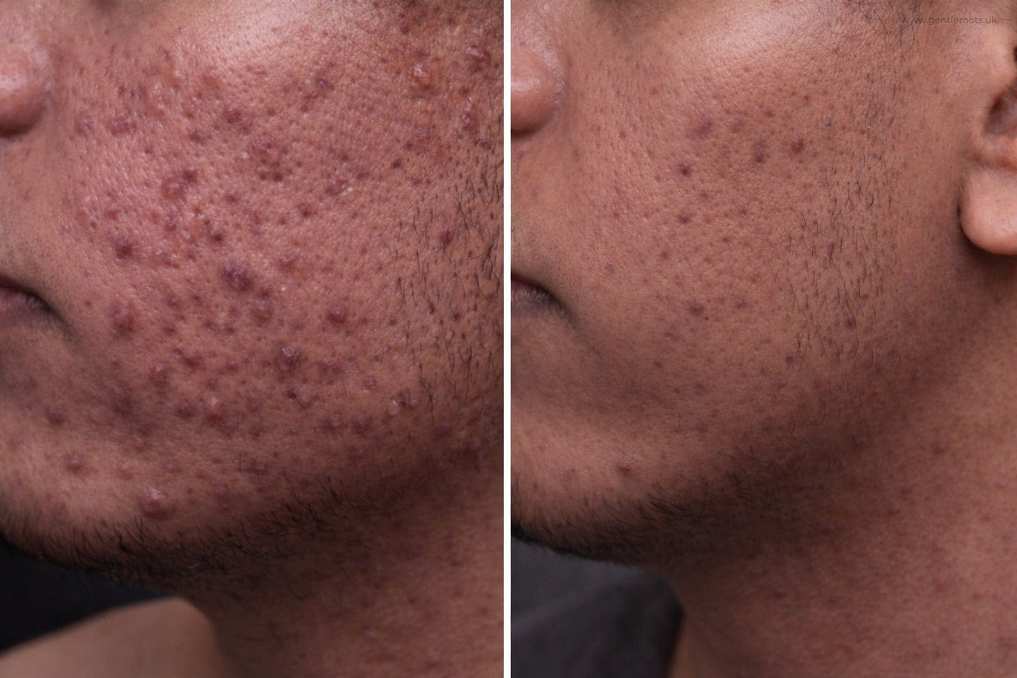 Before and after comparison of acne-prone skin showing clearer complexion and reduced blemishes after consistent natural skincare routine wth gentle roots clarity elixir and detox clay face mask