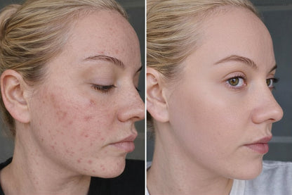 Before and after acne-prone skin improvement showing clearer skin using Gentle Roots natural skincare routine for acne prone skin